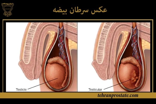 سرطان بیضه: علائم، علل و راههای پیشگیری و درمان 1 عکس سرطان بیضه