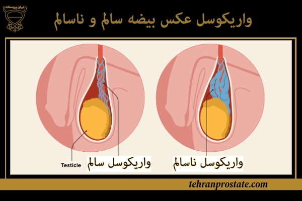 واریکوسل چیست؟ علائم، خطرات و درمان موثر 2 واریکوسل عکس بیضه سالم و ناسالم