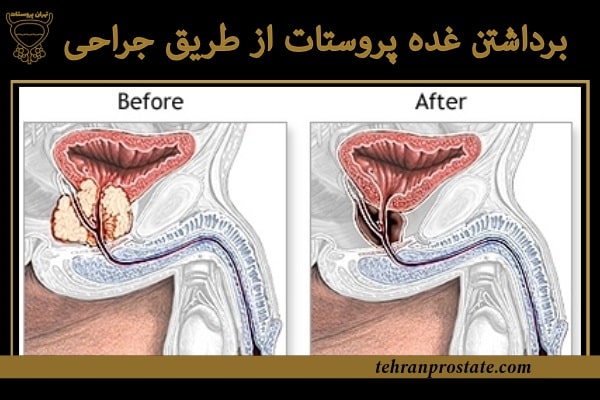 برداشتن غده پروستات از طریق جراحی