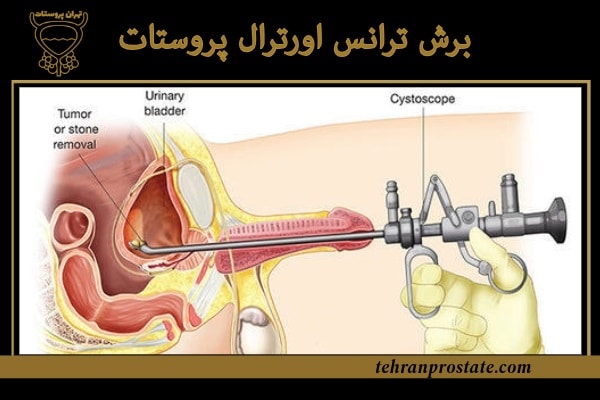 برش ترانس اورترال پروستات (TUIP)