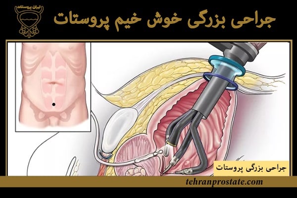 جراحی بزرگی خوش خیم پروستات