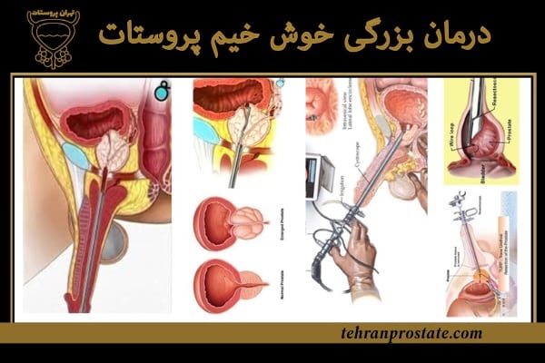 درمان بزرگی خوش خیم پروستات (BPH)