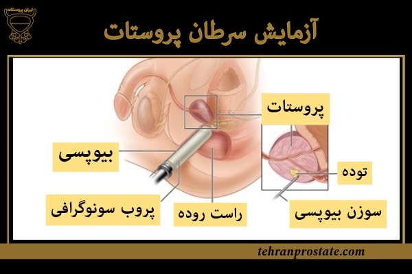 آزمایش سرطان پروستات