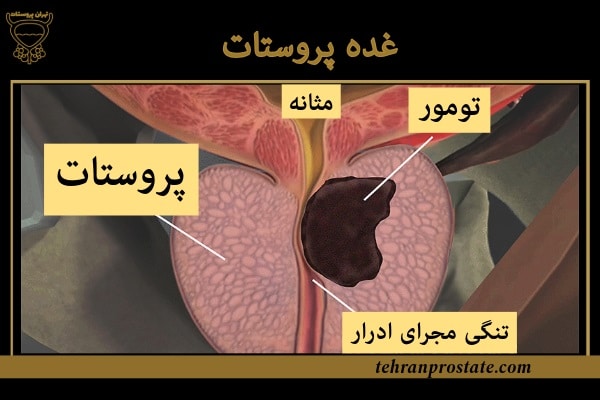 غده پروستات