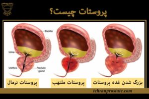 پروستات چیست