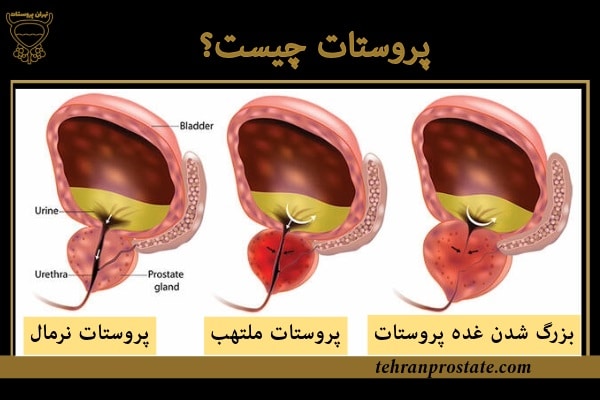 پروستات چیست