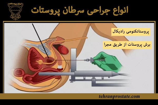 انواع جراحی سرطان پروستات