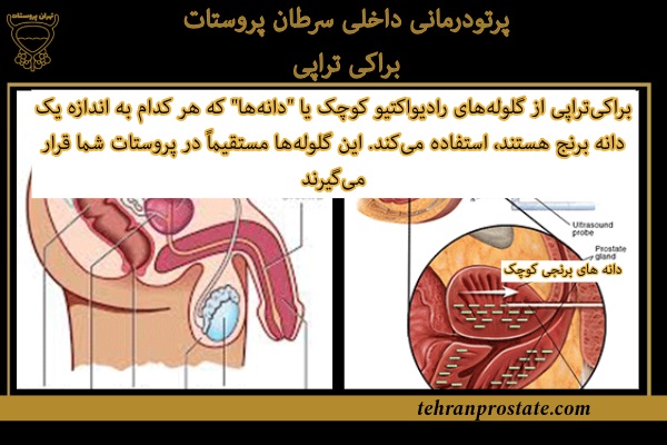 پرتودرمانی داخلی سرطان پروستات