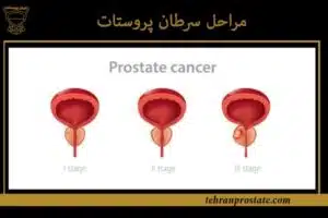 مراحل سرطان پروستات