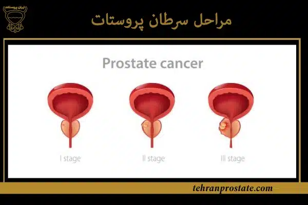 مراحل سرطان پروستات