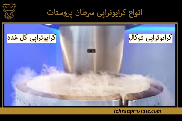 انواع کرایوتراپی سرطان پروستات