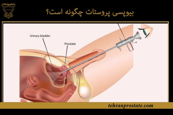 بیوپسی پروستات چگونه است؟