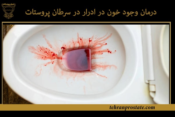 درمان وجود خون در ادرار در سرطان پروستات
