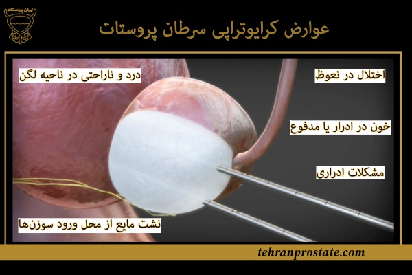 عوارض کرایوتراپی سرطان پروستات