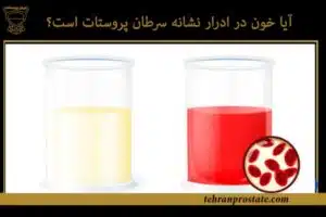 آیا خون در ادرار نشانه سرطان پروستات است؟