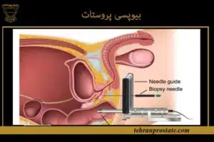 بیوپسی پروستات