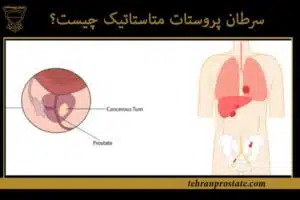 سرطان پروستات متاستاتیک چیست؟