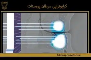 کرایوتراپی سرطان پروستات