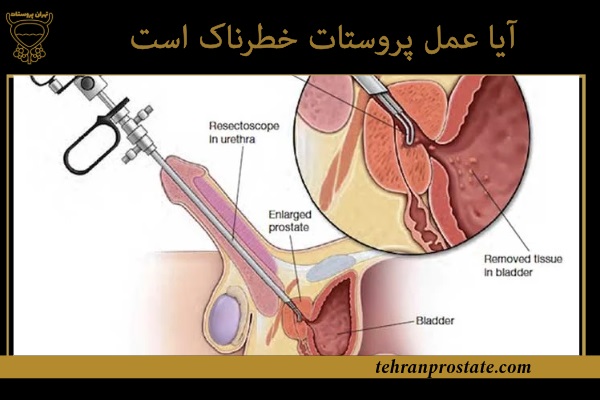 آیا عمل پروستات خطرناک است
