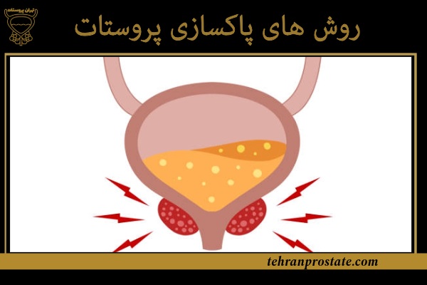 روش های پاکسازی پروستات