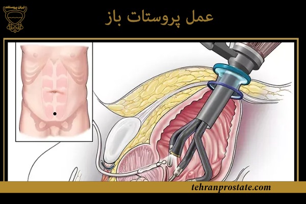 عمل پروستات باز