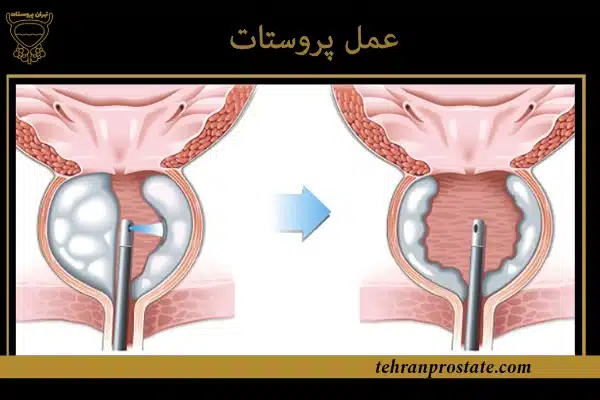 عمل پروستات