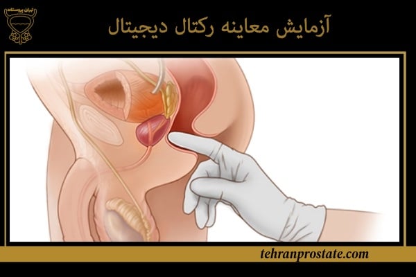 آزمایش معاینه رکتال دیجیتال پروستات