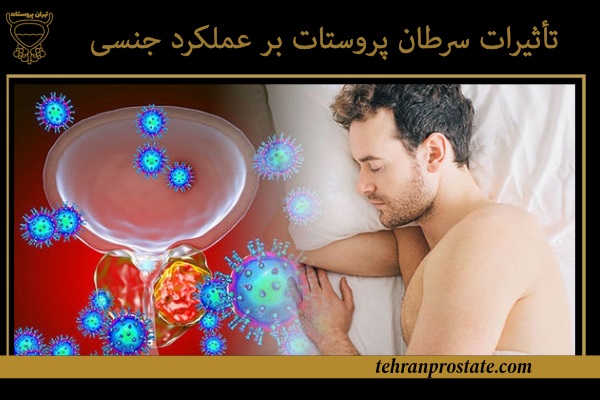 تاثیر سرطان پروستات بر رابطه زناشویی