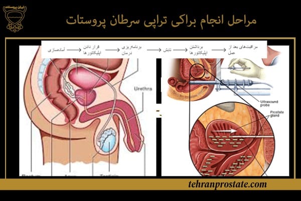 مراحل انجام براکی تراپی سرطان پروستات