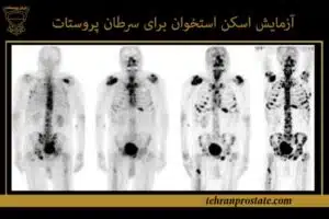 آزمایش اسکن استخوان برای سرطان پروستات