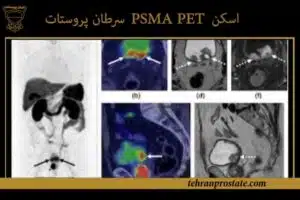 اسکن PSMA PET برای سرطان پروستات