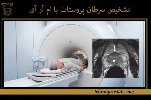 ام‌ آر آی پروستات