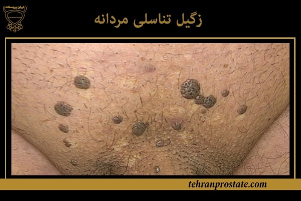 زگیل تناسلی مردانه