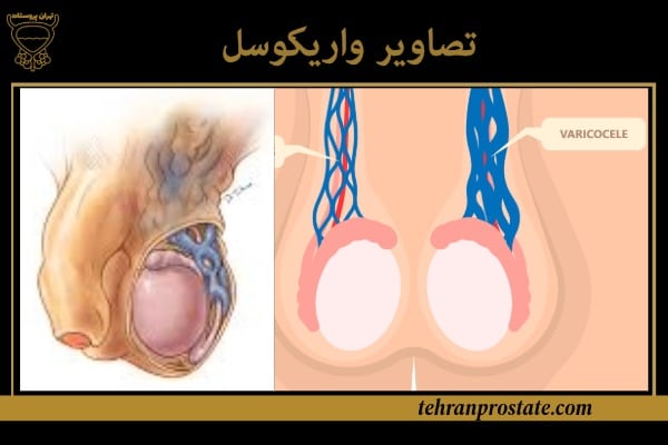 تصاویر واریکوسل