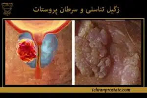 زگیل تناسلی و سرطان پروستات