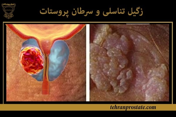 زگیل تناسلی و سرطان پروستات