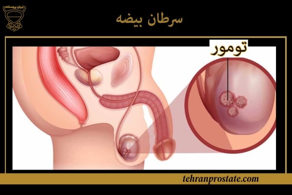 سرطان بیضه