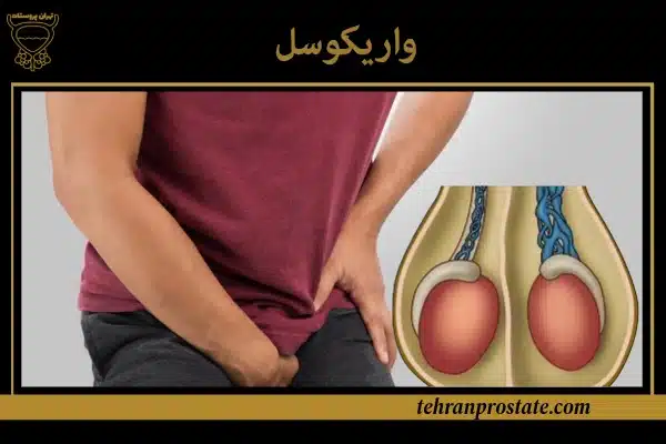 واریکوسل